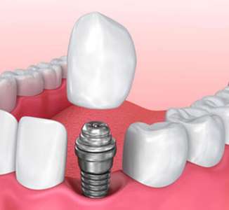 kayıp diş için implant tedavisi