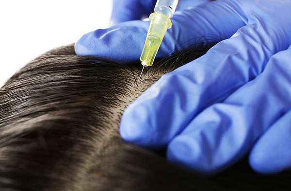 Kök hücre uygulaması ile saç dökülmesi tedavisi