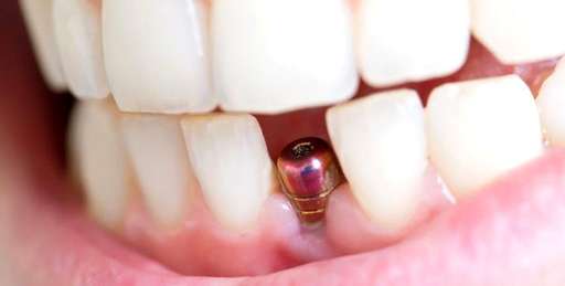 dişçi diş implantı sonucu öncesi sonrası